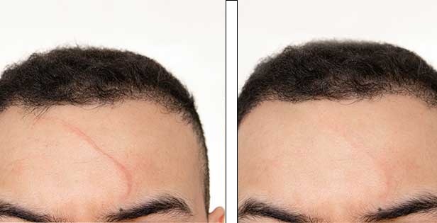 Tratamiento de cicatriz caso 1 — antes y después
